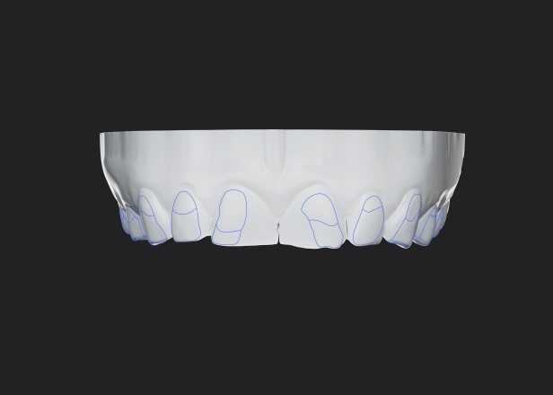 mockup digital, simulación de diseño de sonrisa, carillas estéticas guiadas, sin tallado, mejor clínica dental en Madrid