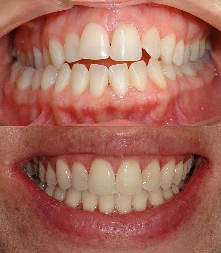 caso real antes y después mordida abierta, especialistas cirugía ortognática madrid, cirujano maxilofacial calvo de mora, tratamientos premium