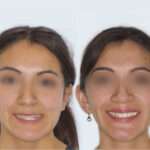 antes y después cirugía ortognática Madrid, Clínica maxilofacial referencia calvo de mora, mentoplastia, operación mordida abierta calidad