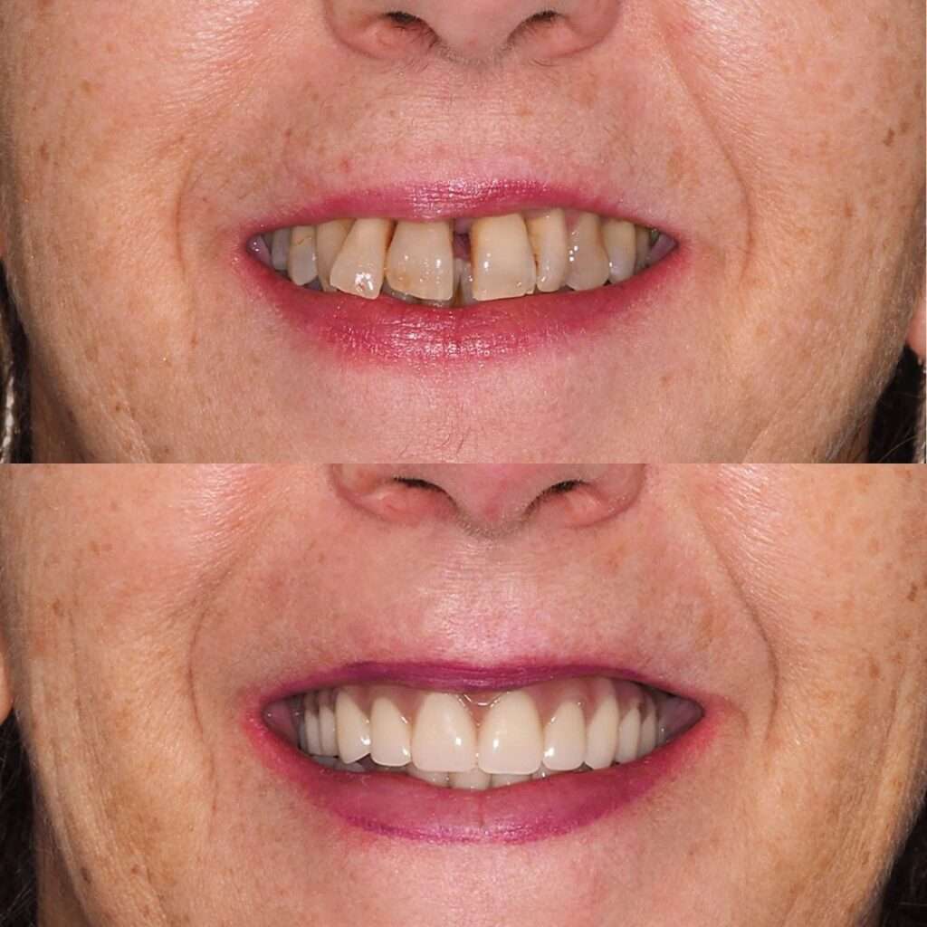 antes y después de implantes dentales en Madrid, implantes de carga inmediata para dientes fijos en el mismo día