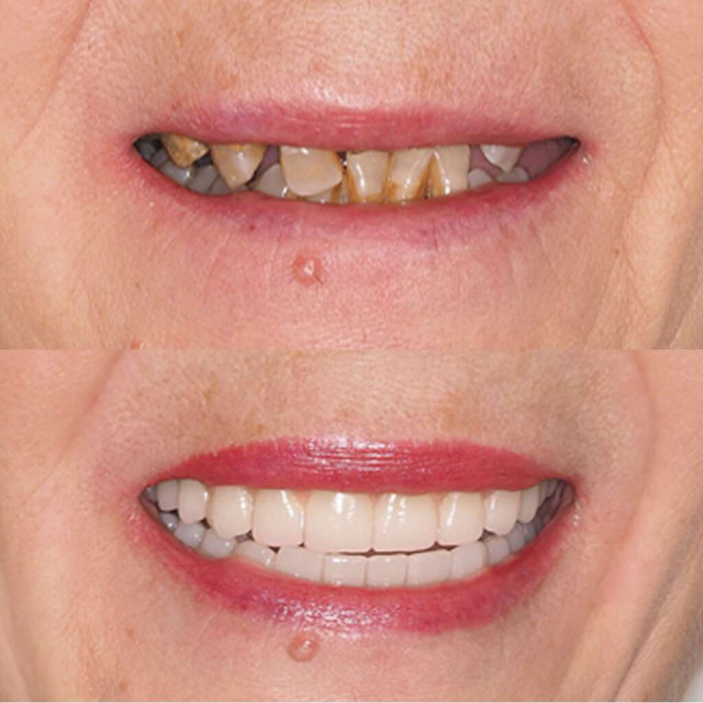 Antes y después de la cirugía de implantes dentales en Madrid, clínica calvo de mora implantes de carga inmediata para dientes fijos