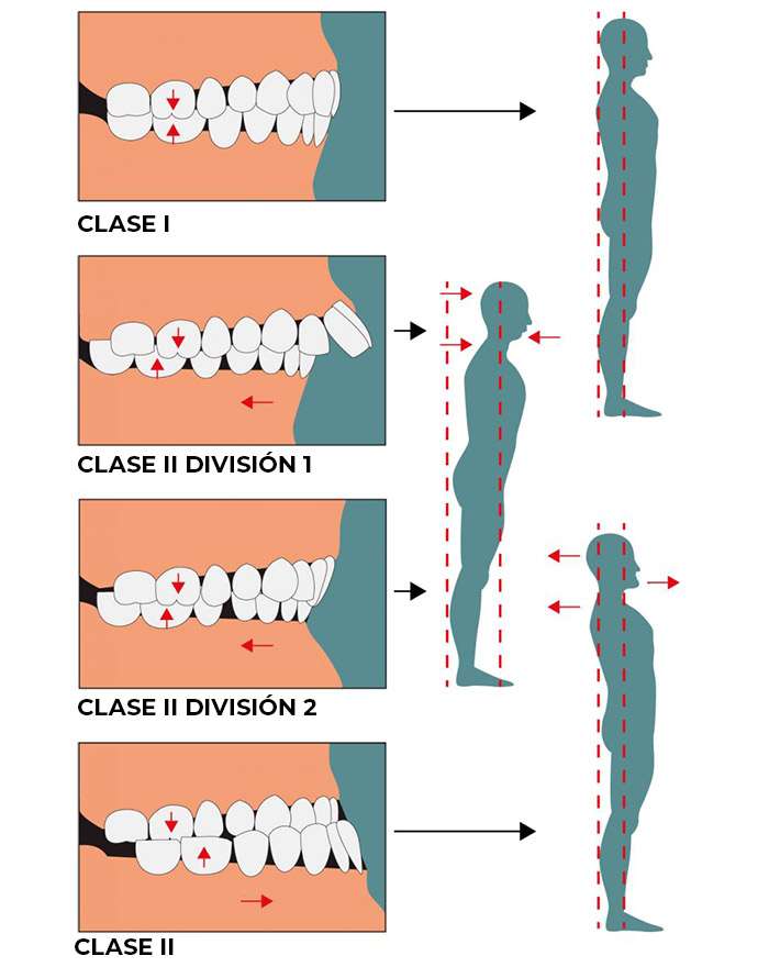 los tipos de mandíbulas desalineadas y cómo afectan a tu postura corporal, ejercicios para mejorar la alineación mandibular y la postura
