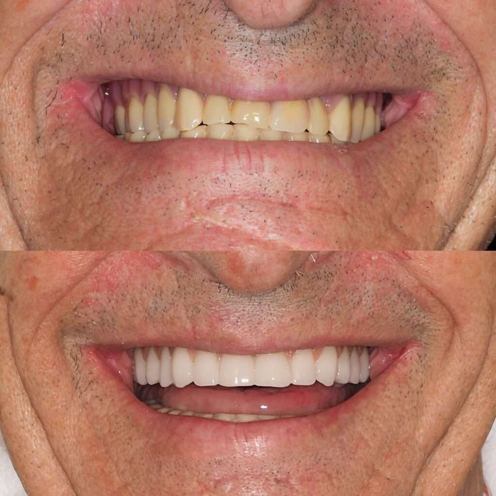 Caso real de un paciente de la clínica dental calvo de mora en Madrid, antes y después de implantes dentales en el mismo día, dientes fijos