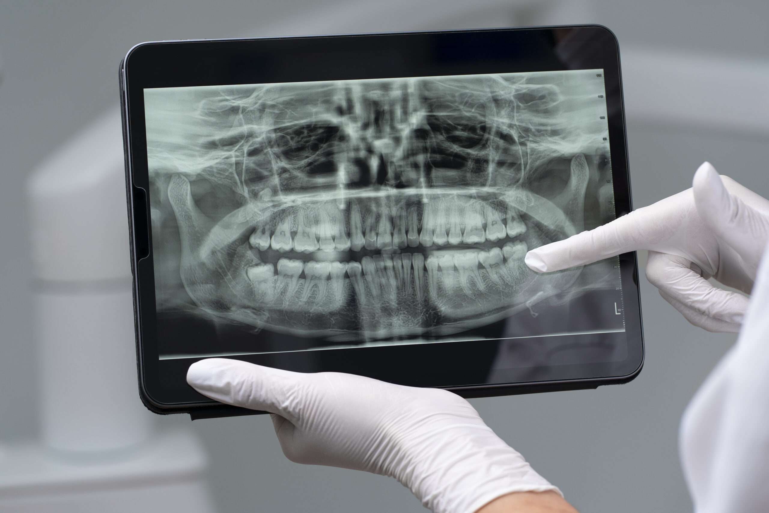 radiografía en dentista para saber si extraer las muelas del juicio, cirujano maxilofacial especializado en quitar las muelas en clínica maxilofacial