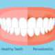diferencia entre dientes sanos y dientes con periodontitis, es posible perder un diente si no se trata a tiempo, clínica dental en Madrid, odontología general