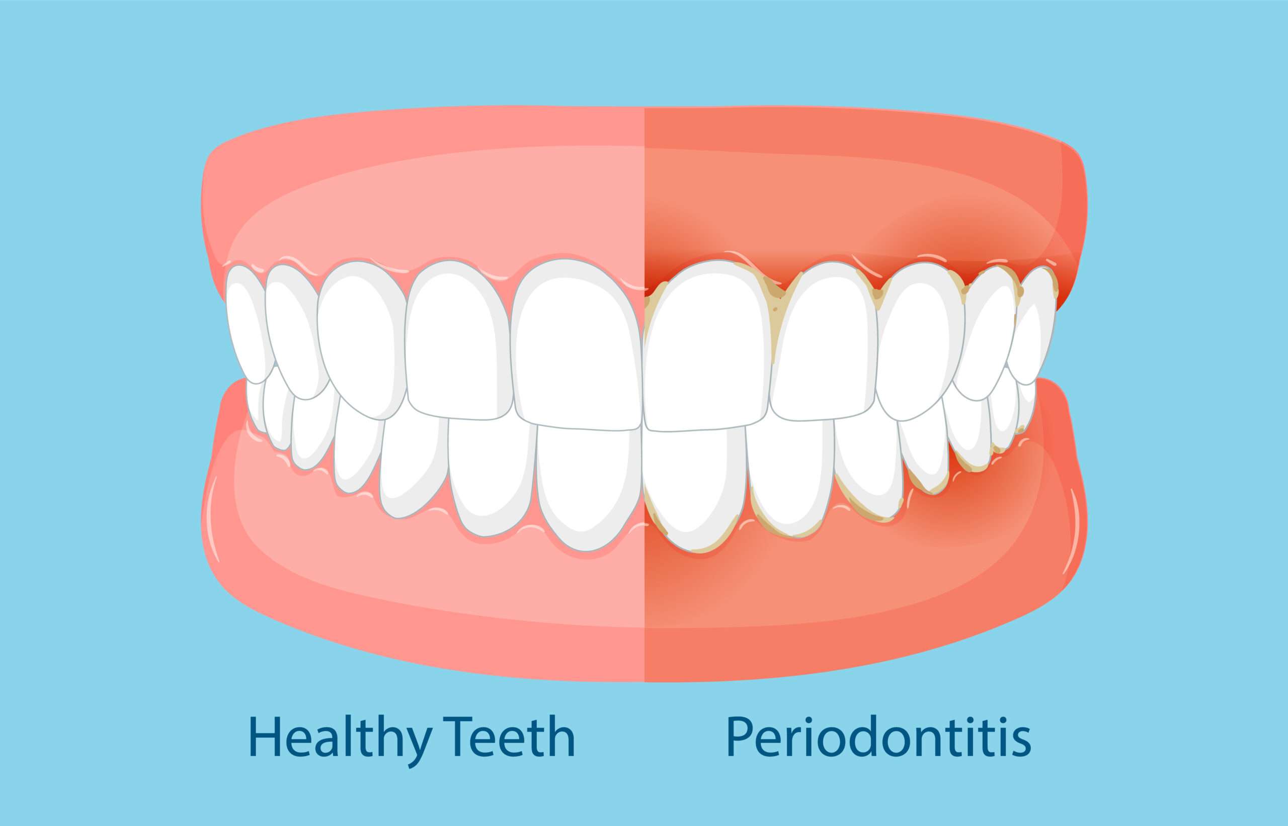 diferencia entre dientes sanos y dientes con periodontitis, es posible perder un diente si no se trata a tiempo, clínica dental en Madrid, odontología general