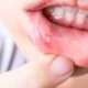 llagas en la boca, úlceras, aftas bucales, heridas en la boca por uso de Brackets y piercing lingual, causas y tratamiento en clínica dental en Madrid