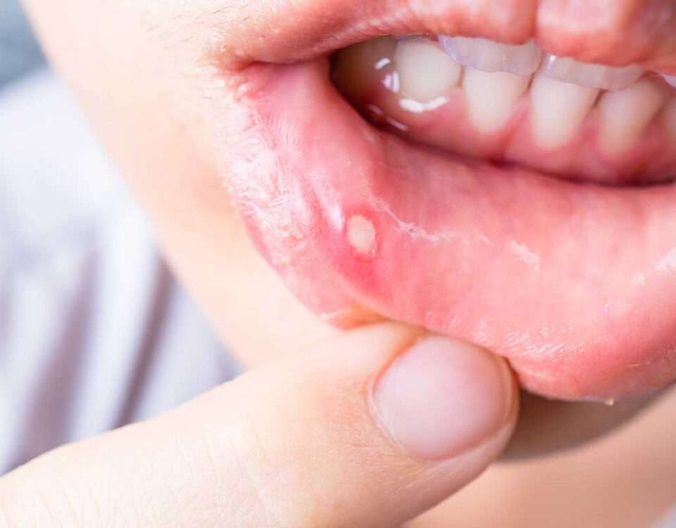 llagas en la boca, úlceras, aftas bucales, heridas en la boca por uso de Brackets y piercing lingual, causas y tratamiento en clínica dental en Madrid