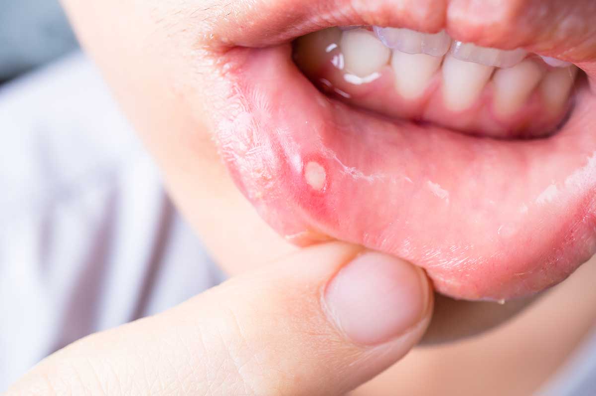 llagas en la boca, úlceras, aftas bucales, heridas en la boca por uso de Brackets y piercing lingual, causas y tratamiento en clínica dental en Madrid