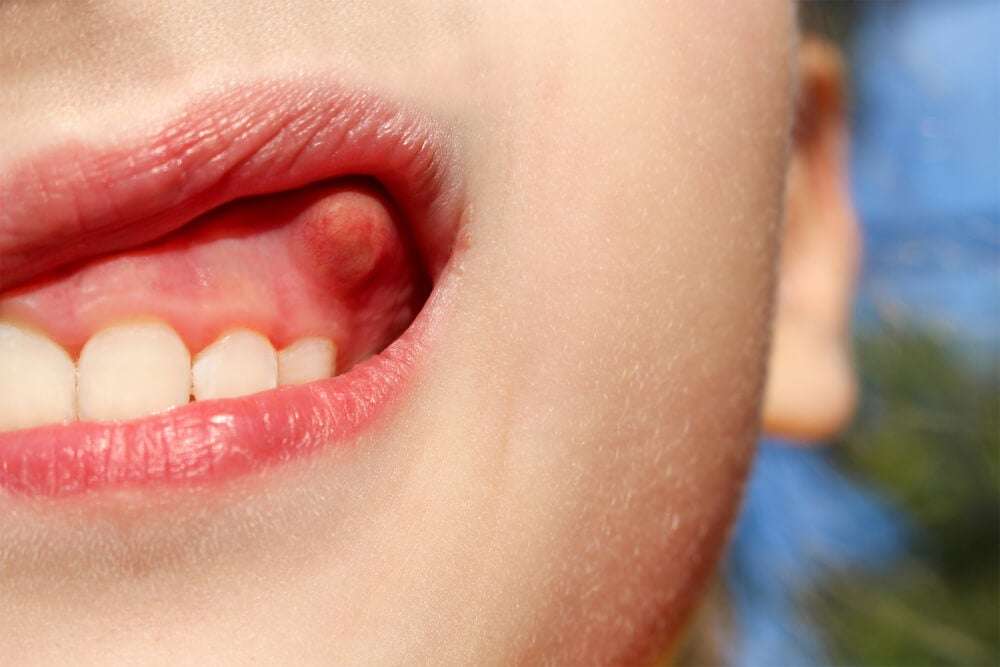 Causas de los flemones dentales, que son y cómo se trata un flemón en la encía, acude a tu dentista de confianza lo antes posible