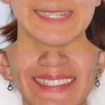 antes y después de paciente real cirugía ortognática bimaxilar en la clínica maxilofacial calvo de mora en Madrid, caso de éxito