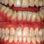 Antes y después cirugía ortognática real, caso de éxito, operación para corregir la mordida abierta en clínica maxilofacial calvo de mora