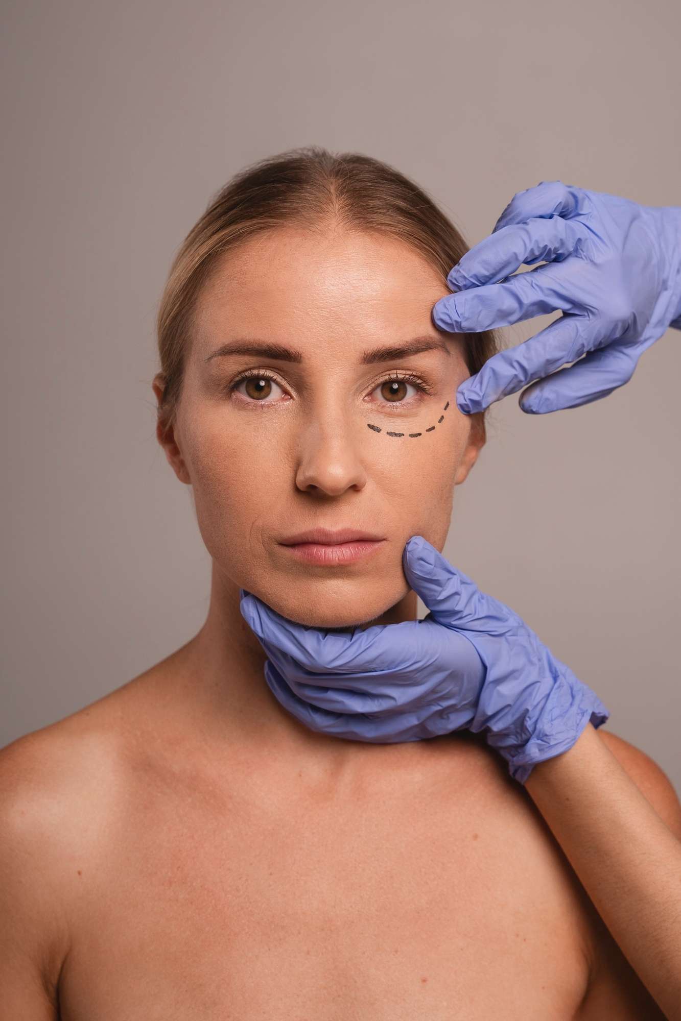 Señales claras de que el exceso de párpado tiene solución en clínica especializada en Madrid, párpado caído, blefaroplastia, eliminar exceso de piel en los párpados