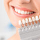 Carillas dentales