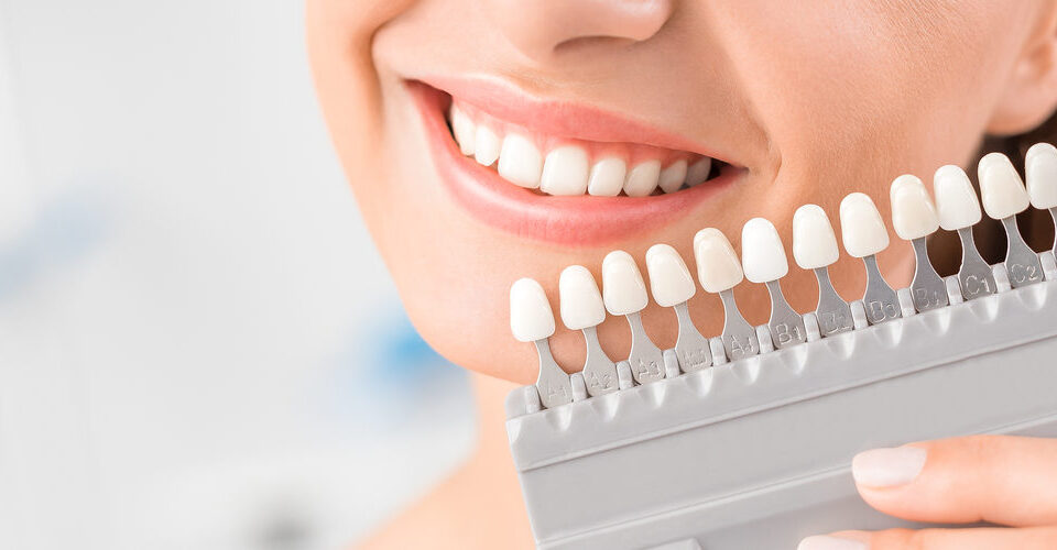 Carillas dentales