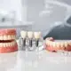 Mejores alternativas a dentadura removible
