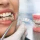 Cómo alinear dientes apiñados con precisión