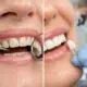 Cómo renovar una sonrisa desgastada con precisión